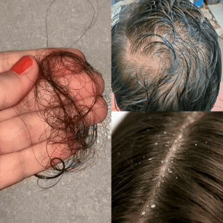 Hair shedding after every wash