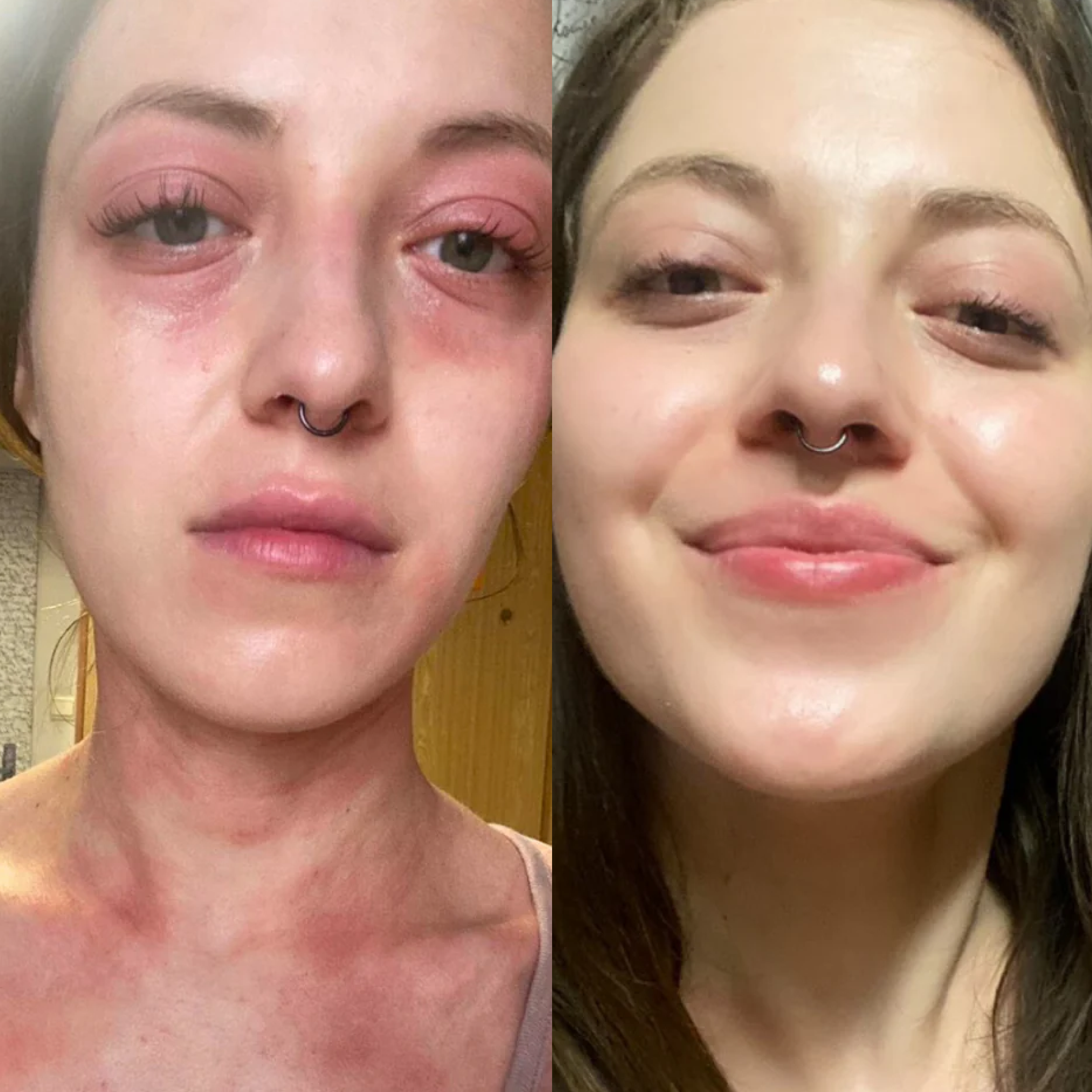 Calmer skin by month one to two